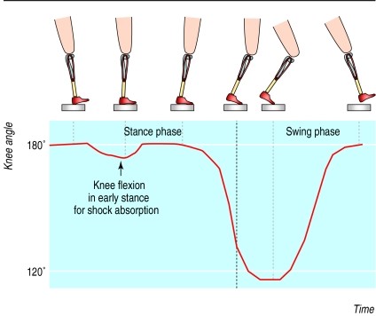 Advance prosthetic knee