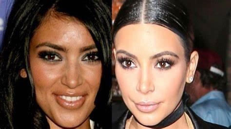 Kim Kardashian's plastic surgery timeline-before and after