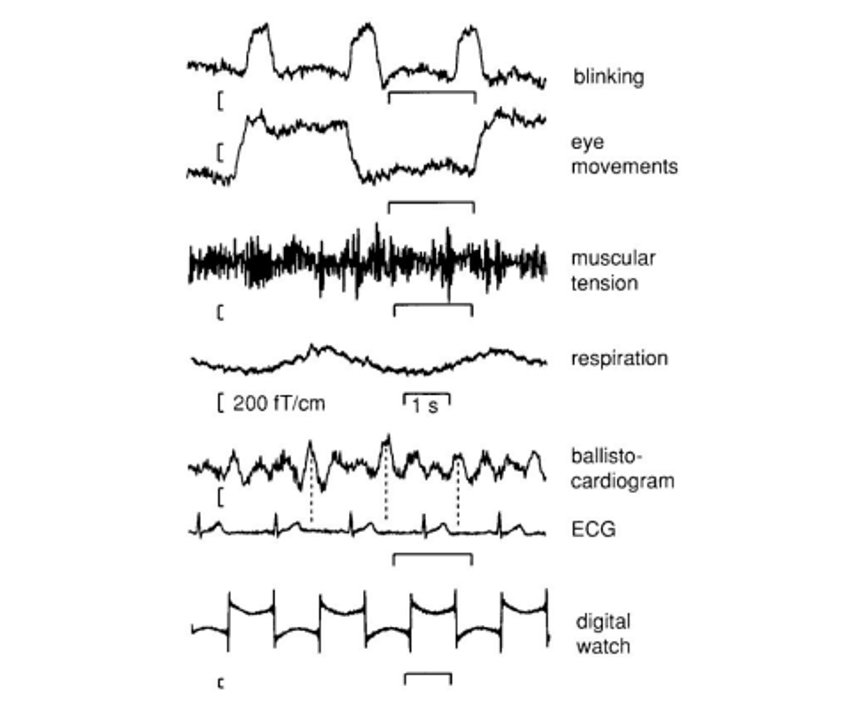 Figure 1.5: MEG acquisition-related common artifacts.