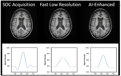 Brain MRI comparison showing SOC acquisition